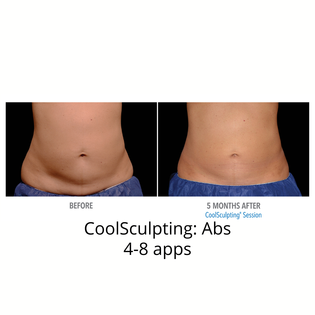 CoolSculpting Elite