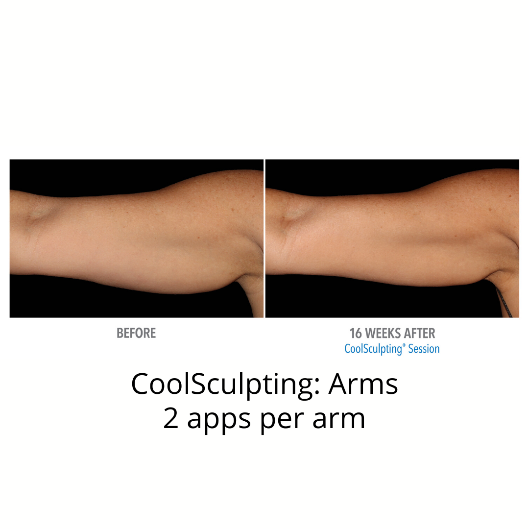 CoolSculpting Elite