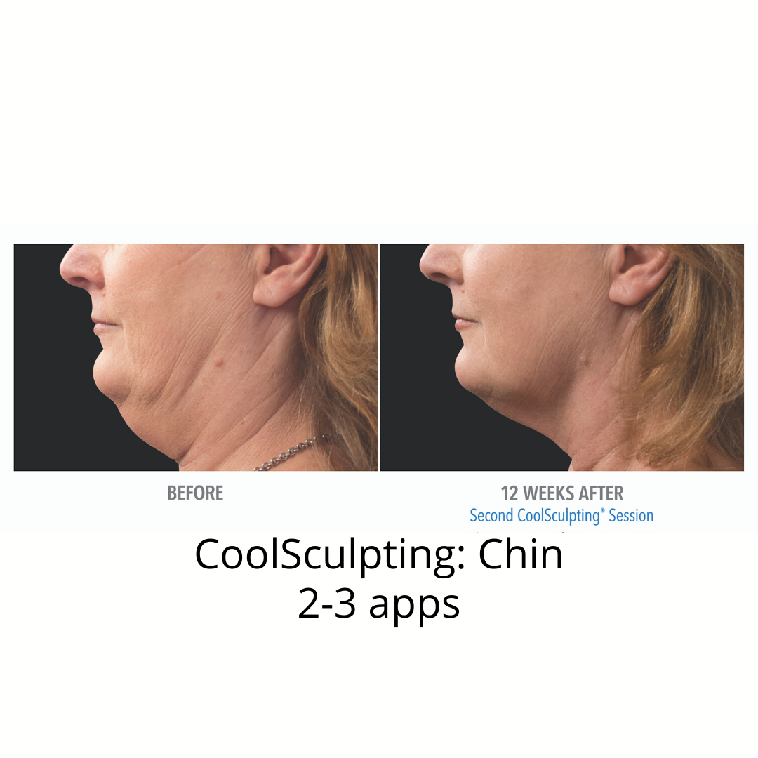 CoolSculpting Elite