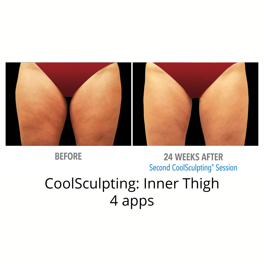 CoolSculpting Elite