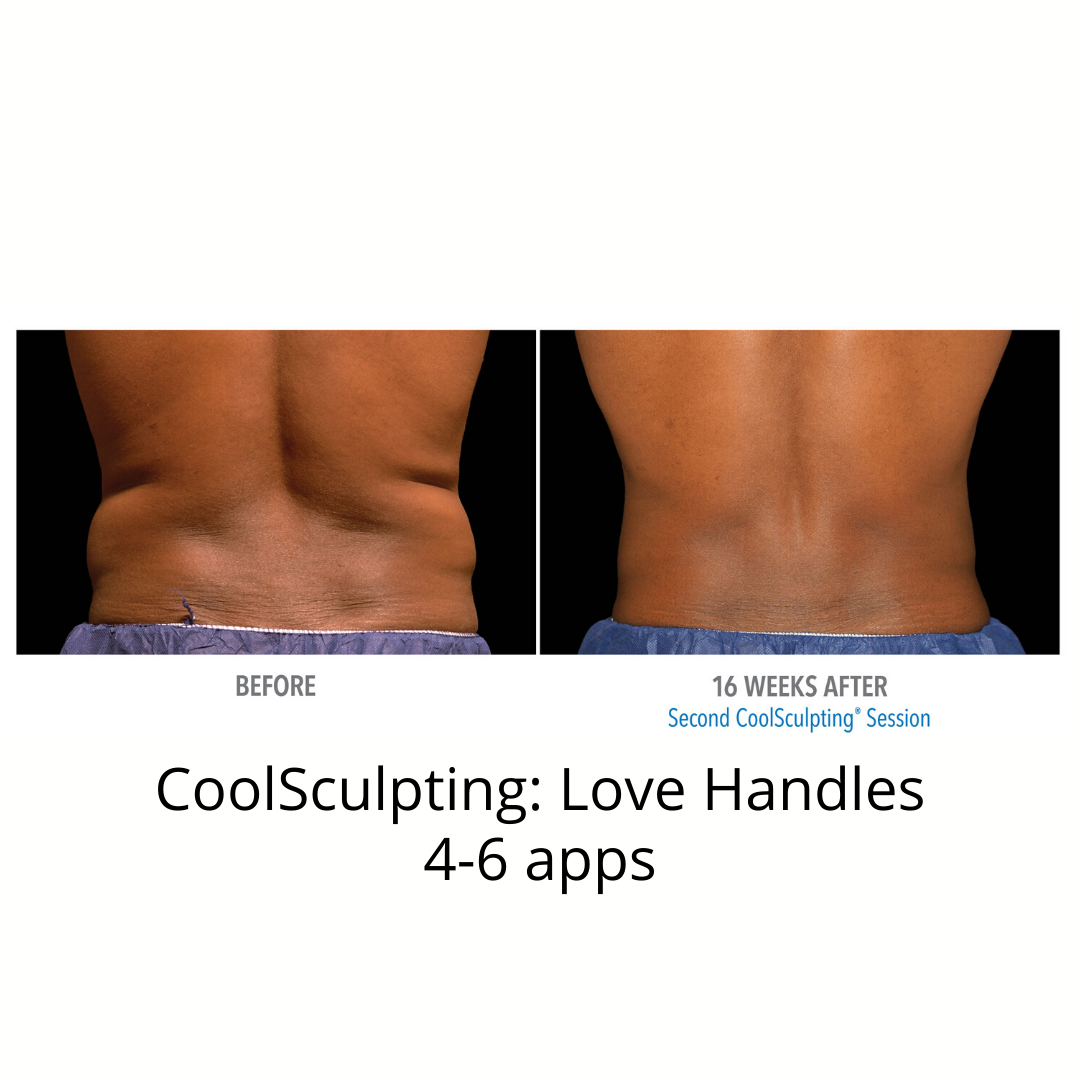 CoolSculpting Elite