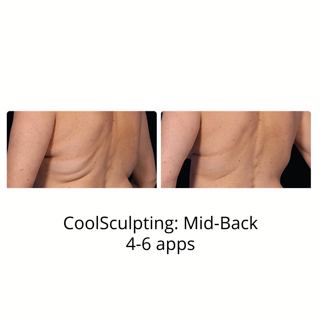 CoolSculpting Elite