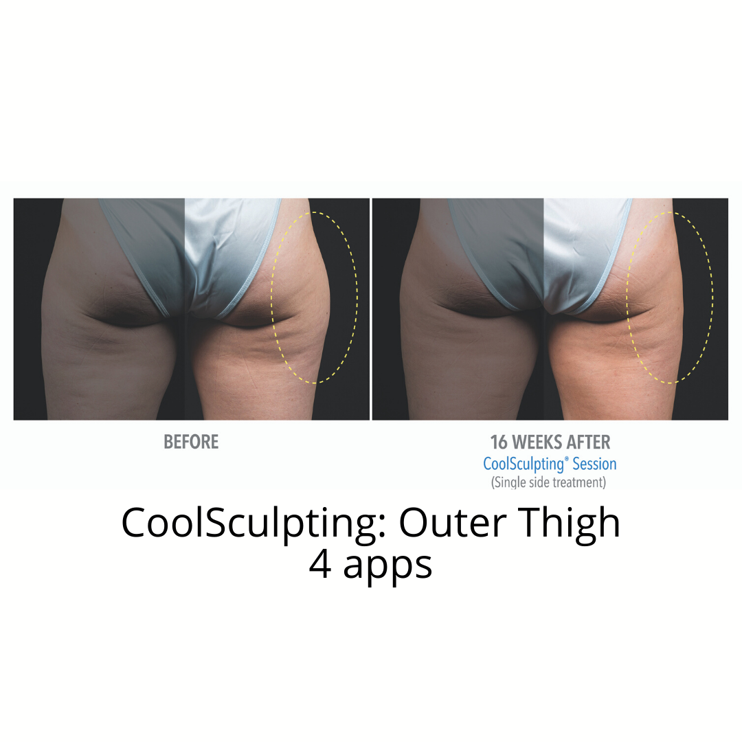 CoolSculpting Elite